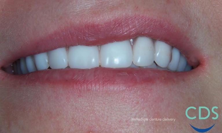 Full-Dentures-After-Image