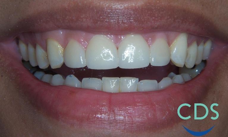 Spaces-between-teeth-fixed-with-veneers-After-Image