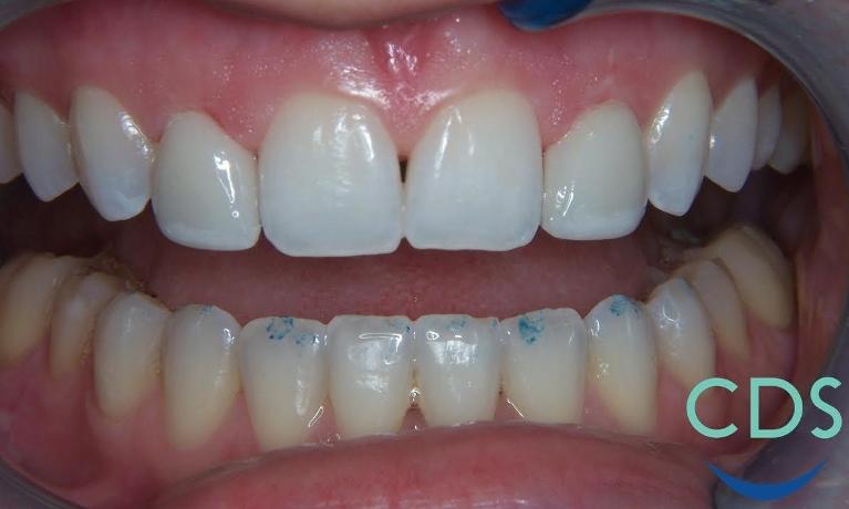 Veneers-After-Image