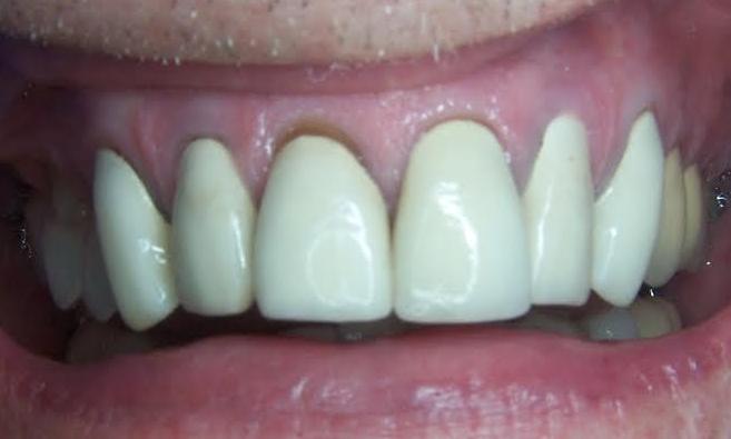 Crowns-Before-Image