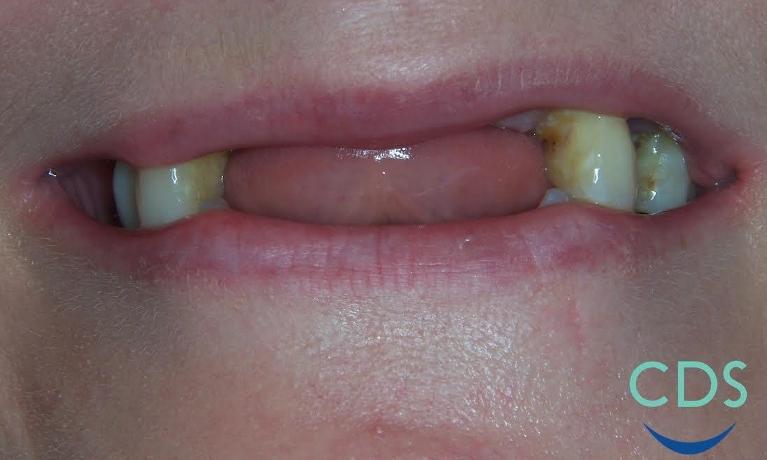 Full-Dentures-Before-Image