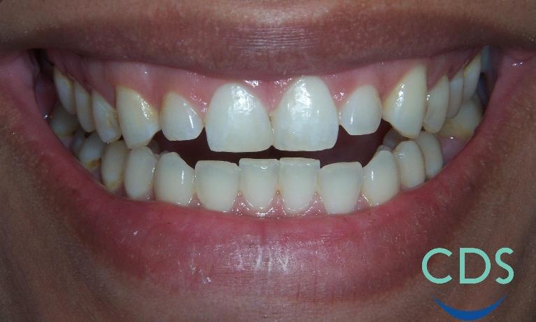 Spaces-between-teeth-fixed-with-veneers-Before-Image