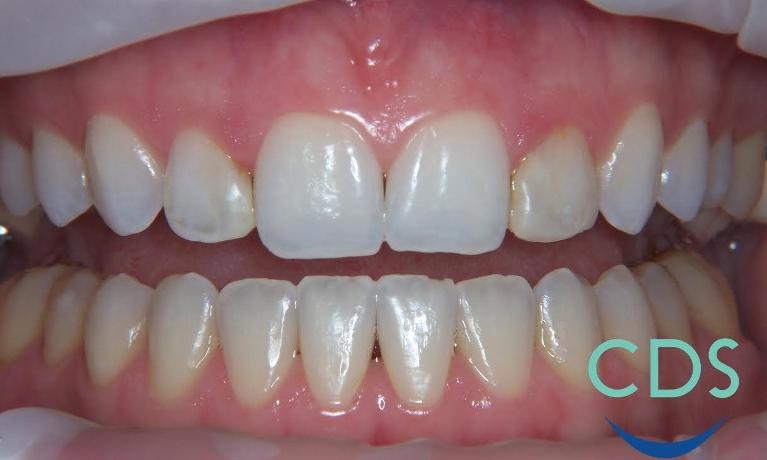 Veneers-Before-Image